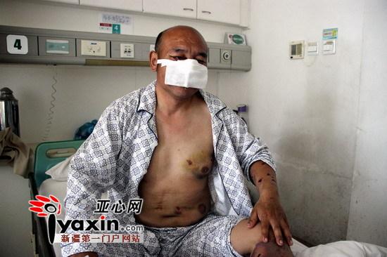新疆沙灣村民山中撿玉遭棕熊攻擊 鼻子、上嘴唇被咬掉撿回一命（圖）