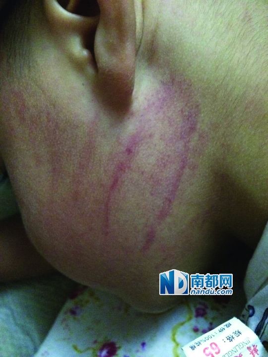 小逸臉上淤痕清晰可見。