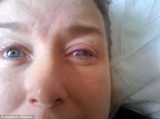 恐怖慎入！隱形眼鏡致英女子摘除眼球