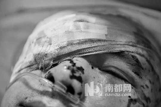 李建新頭部還有被潑硫酸的痕跡，醫(yī)生說被砍傷的右眼已經(jīng)失明。 南都記者 田飛 攝