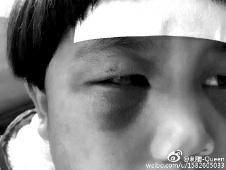 6月2日，網(wǎng)曝渭南市臨渭區(qū)一不滿5歲的女童遭奶奶毆打，眼圈青腫，引起網(wǎng)友關(guān)注，但孩子父母和爺爺均稱是摔倒導(dǎo)致。相關(guān)部門介入調(diào)查發(fā)現(xiàn)確為奶奶毆打所致，鑒于其身體原因已進(jìn)行批評(píng)教育。