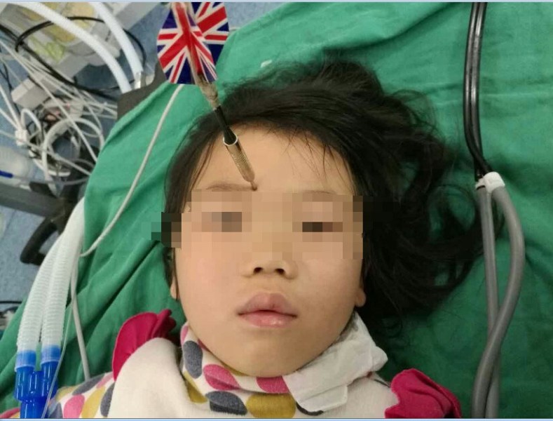十多公分長(zhǎng)的飛鏢穩(wěn)穩(wěn)地 ” 定 ” 在了一名六歲半的女童額頭上，小青一家人凌晨從長(zhǎng)順趕到貴醫(yī)附院急診室時(shí)，看到如此慘烈的情況，接診醫(yī)生都嚇了一跳。詳細(xì)詢問(wèn)下得知，原來(lái)是七歲的哥哥和六歲半的表妹在玩耍時(shí)，哥哥不慎將路邊撿來(lái)的真飛鏢扎到了妹妹的額頭上。