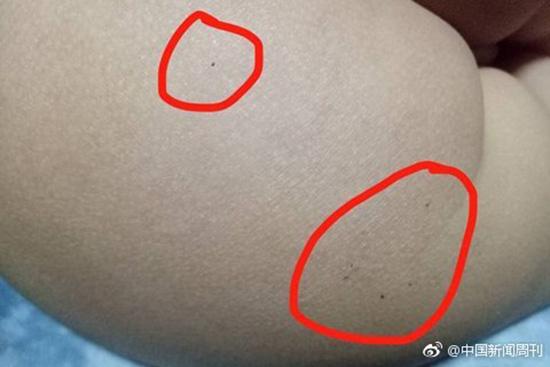 據(jù)多名紅黃藍(新天地分園)家長反映，孩子腿部、屁股、腋下出現(xiàn)針眼。