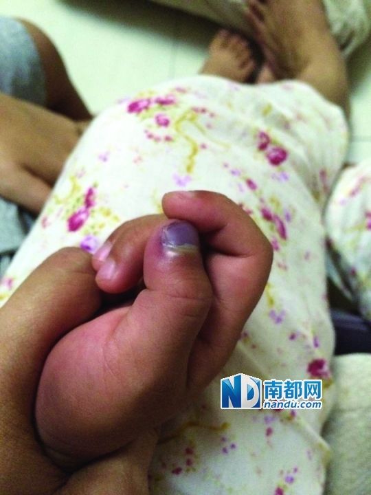小逸手指被夾傷。