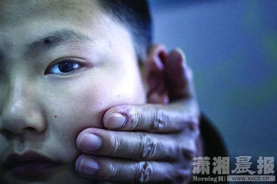 1月13日，小玨的父親心疼地摸著兒子的臉。